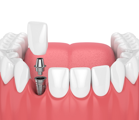 Making Your Implant Crowns Last