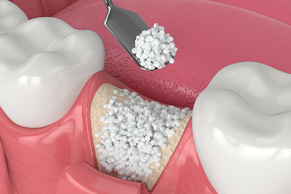 When A Bone Graft Is Needed For An Implant Dentistry Procedure